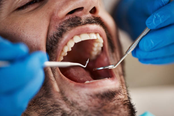 Best Emergency Wisdom Tooth Extraction in Westover, AL