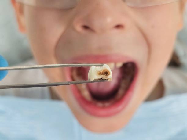Best Emergency Treatment for Oral Infections in Westover, AL
